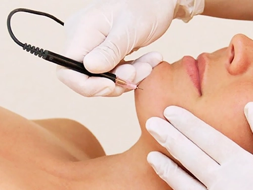 electrolysis hair removal procedure clean clinic